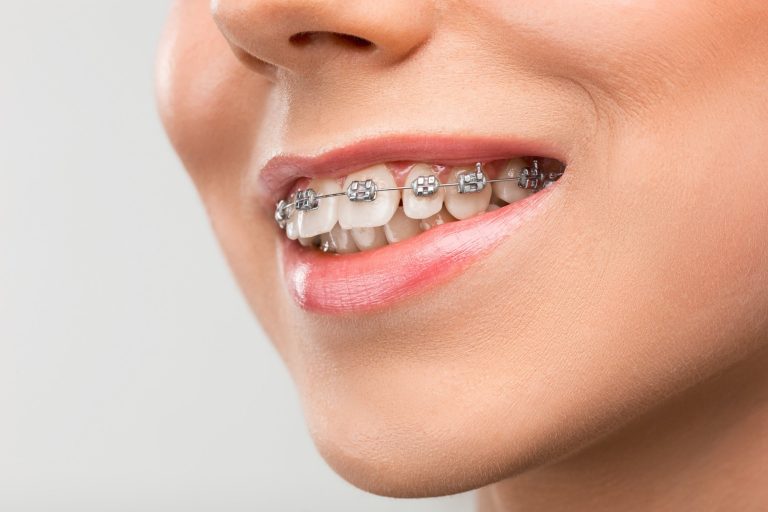 Beyond Braces: Innovative Solutions for Straightening Teeth