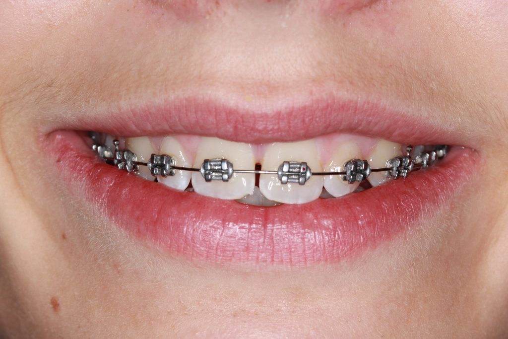 Engineering Smiles: How Braces Influence Facial Symmetry