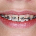Engineering Smiles: How Braces Influence Facial Symmetry