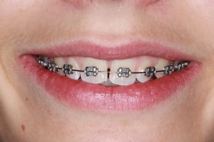 Engineering Smiles: How Braces Influence Facial Symmetry