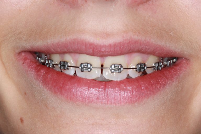 Engineering Smiles: How Braces Influence Facial Symmetry
